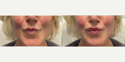 45-54 year old woman treated with Restylane, Restylane Refyne, Volbella, Juvederm, Vollure - A woman in her 50s, after the injection of filler into the upper and lower lips. Perioral lines were treated as well.