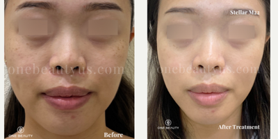 25-34 year old woman treated with Stellar M22 - mid 20s year old treated with Stellar M22 for spot & pigmentation