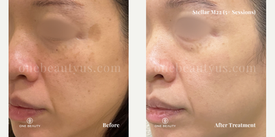 35-44 year old woman treated with Stellar M22 - mid 30s year old treated with Stellar M22 for spot & pigmentation