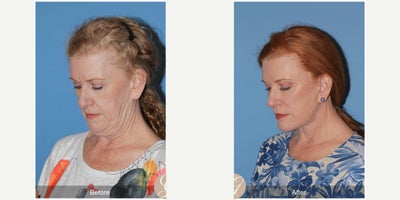 62 year old woman treated with Deep Plane Facelift, Neck Lift, Botox, MACS Facelift - 62 year old woman treated with Deep Plane Face and Neck Lift, Fat Grafting to Cheeks, Botox, MAC