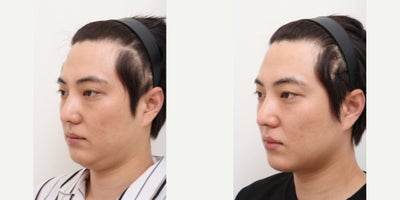 25-34 year old man treated with AccuLift, Laser Liposuction - 29 Years old male patient Chief Complain: double chinTreatment Plan:   double chin liposuction and chin muscle liftOutcome:  - double chin liposuction pure fat : 25cc- lifted jaw line reached by chin muscle lift