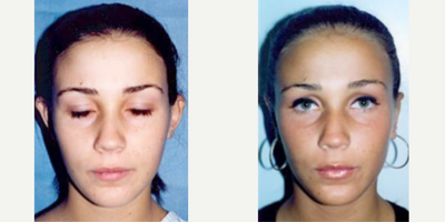 Woman treated with Ear Surgery - Woman treated with Ear Surgery