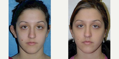 Woman treated with Ear Surgery - Woman treated with Ear Surgery