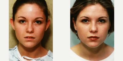 Woman treated with Ear Surgery - Woman treated with Ear Surgery