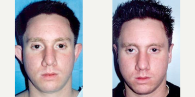 Man treated with Ear Surgery - Man treated with Ear Surgery
