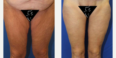 45-54 year old woman treated with Thigh Lift - This 53-year-old female initially weighed 245 pounds and with gastric sleeve surgery, lost 80 pounds. So, Dr. Katzen performed a medial thigh lift. Please note that the patient had also undergone a tummy tuck.