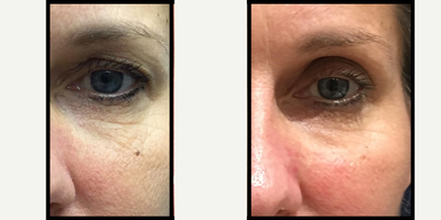 45-54 year old woman treated with MiXto Laser - The MiXto SX is a cutting-edge laser skin treatment that decreases sun damage, wrinkles, crepey skin, acne scars and tightens the skin, all with a more acceptable amount of downtime.