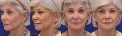 Xeomin, Restylane, Face and Necklift, and Neck Suture Suspension - 70 Year-old woman treated with Xeomin, Restylane, Face and Necklift, and Neck Suture Suspension.