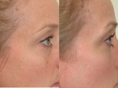 Pearl Laser Treatment - Pearl laser-one treatment