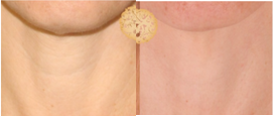 45-54 year old woman treated with Pelleve - Pelleve can be used to tighten the neck and reduce wrinkles as well.