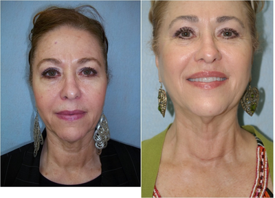 InMode Fractora to the Face and Neck  - One treatment at 45 mj with 24 and 60 pin tips2 full passes stacked, patient 62 years oldSkin resurfacing and tightening, fine lines and wrinkles