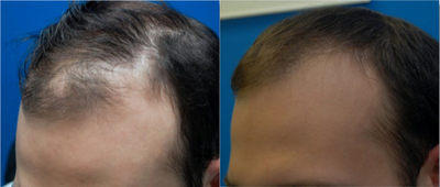 Man treated with Hair Loss Treatment - 1769 grafts