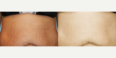 37 year old female underwent 6 sessions of microneedling for stretch marks of the abdomen. - 37 year old female who underwent six sessions of microneedling at 2 mm depth for stretch marks of the abdomen.