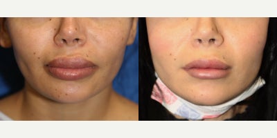 Upper and Lower Lip Silicone Removal surgery for Firmer Healthier Contour - A more natural lip appearance can often be achieved by carefully removing harmful foreign material from the lips. Our patient is a 28-year-old White female who came to Dr. J. Timothy Katzen because of previously injected foreign bodies in both her upper and lower lips. She was most concerned about the retained material, the scar tissue surrounding it, and the risk of granulomas and associated cancer. To treat these issues, Dr. Katzen performed silicone injection removal of the lips under general anesthesia. In this procedure, the abnormal injected material is carefully identified within the lip tissue and surgically excised. At the same time, any problematic scar tissue is also addressed to help restore a smoother contour. Lip foreign body removal is an advanced reconstructive procedure because the surgeon must remove harmful material without overly disrupting the natural architecture of the lips. These injections can cause chronic swelling, firmness, nodules, uneven shape, and visible lip distortion that cannot be corrected without surgery. By removing the foreign bodies and refining the tissue, this procedure can improve both safety and appearance. Her after photos were taken just 2 weeks after surgery and already show remarkable results, including better symmetry, softer-looking lips, and a healthier overall contour. Since healing is still in the early phase, her progress is especially impressive and should continue to improve over time.