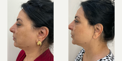 35-44 year old woman treated with Morpheus8 - Morpheus 8 face and neck.