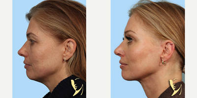 45-54 year old woman treated with Facelift, Lower Facelift, Brow Lift, Rhinoplasty - Lower Facelift, Brow Lift, Rhinoplasty (Nose Reshaping)  by Burke Robinson, MD, FACS