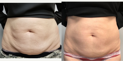 35-44 year old woman treated with Velashape - 6 VelaShape III, pictures taken at 6th treatment.