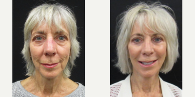 65-74 year old woman treated with Facelift, Facial Fat Transfer, Brow Lift, Eyelid Surgery - 71 y.o. female who received a facelift with fat grafting, upper and lower lid blepharoplasty and browlift.