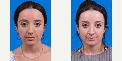 25-34 year old woman treated with Rhinoplasty, Septoplasty - 27 year old woman treated with a septorhinoplasty. Her photos show a nine month difference of before and after the septorhinoplasty.