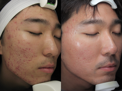 25-34 year old man treated with Intracel - Patient had 2 Intracel treatments on his cheeks and temples