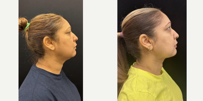 45-54 year old woman treated with FaceTite - Chin and neck liposculpting, facetite