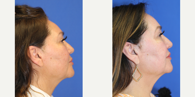 55-64 year old woman treated with Chemical Peel - This is a 57 year old Hispanic patient who was not happy with the uneven skin coloring, fine lines, and dark spots in her face. She had a chemical peel with Dr. J. Timothy Katzen in Beverly Hills, CA.  Notice the improvement in her skin, improved fine lines and dark spots.