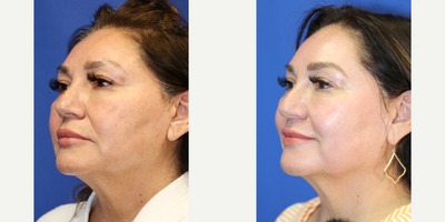 55-64 year old woman treated with Chemical Peel - This is a 57 year old Hispanic patient who was not happy with the uneven skin coloring, fine lines, and dark spots in her face. She had a chemical peel with Dr. J. Timothy Katzen in Beverly Hills, CA.  Notice the improvement in her skin, improved fine lines and dark spots.