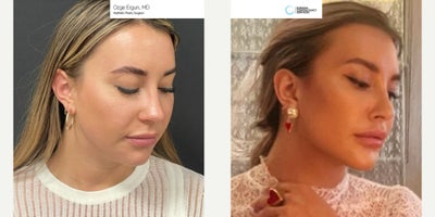 25-34 year old woman treated with Chin Implant, Jaw Implants - Chin & Jaw Implant Surgery