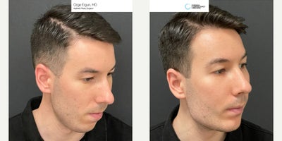 25-34 year old man treated with Chin Implant, Jaw Implants - Chin & Jaw Implant Surgery