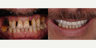 55-64 year old man treated with Dental Implants, Dental Bridge, Smile Makeover - The teeth of our patient, who had advanced mobility in his teeth due to periodontal disease, were extracted and dental implants were placed at the same time. After the fusion of the implants with the bone, the treatment with implant supported crowns was completed.