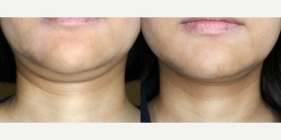 Woman treated with ULTRAcel - Woman treated with ULTRAcel