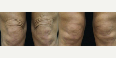 Woman treated with ULTRAcel - Woman treated with ULTRAcel