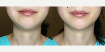Woman treated with ULTRAcel - Woman treated with ULTRAcel