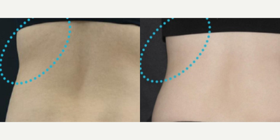 Woman treated with ULTRAcel - Woman treated with ULTRAcel