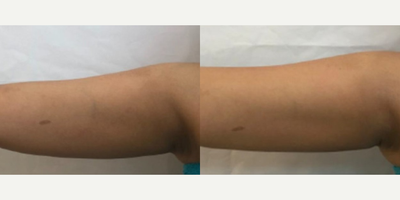 Woman treated with ULTRAcel - Woman treated with ULTRAcel