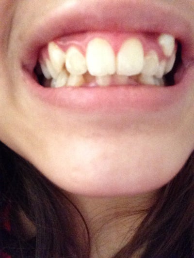 What do I do with my exposed canine tooth which is above my baby tooth ...