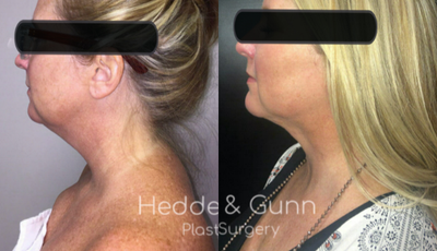 45-54 year old woman treated with Liposuction - Liposuction to the neck