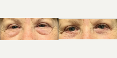 65-74 year old woman treated with Eyelid Surgery - Lower eyelid surgery performed by Dr. Hodge.