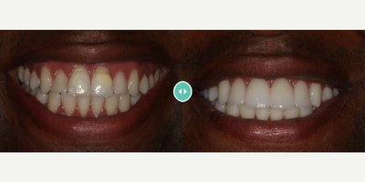 Man treated with Pinhole Gum Surgery - Man treated with Pinhole Gum Surgery