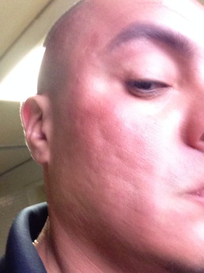 What procedure would you recommend to get rid of acne What procedure would you recommend to get rid of acne