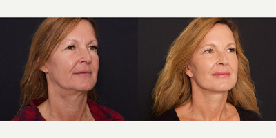 Woman treated with Dysport - Woman treated with Dysport
