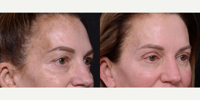 Woman treated with Chemical Peel - Woman treated with Chemical Peel