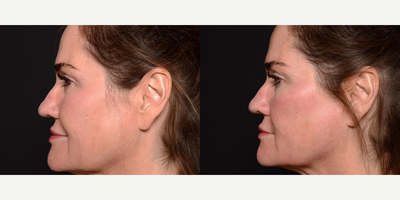 Woman treated with Aquagold - Woman treated with Aquagold