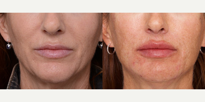 Woman treated with Bellafill - Woman treated with Bellafill