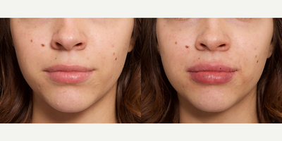 Woman treated with Lip Fillers - Woman treated with Lip Fillers