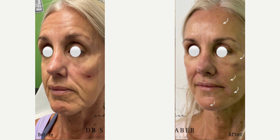 45-54 year old woman treated with Nonsurgical Facelift, Ellanse, Collagen Injection, Silhouette Soft - Non- Surgical Facelift