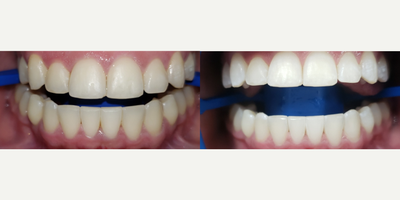 18-24 year old woman treated with Zoom Whitening - Zoom whitening completed in 1 hour in office