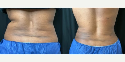 45-54 year old woman treated with Tickle Lipo - Tickle Lipo