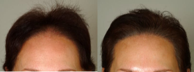 65-74 year old woman treated with Scalp Micropigmentation - 65 year old woman after three sessions of SMP