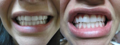 Zoom Teeth Whitening - 
	Teeth were whitened using Zoom Teeth Whitening. The discoloration and yellowness are completely removed.
